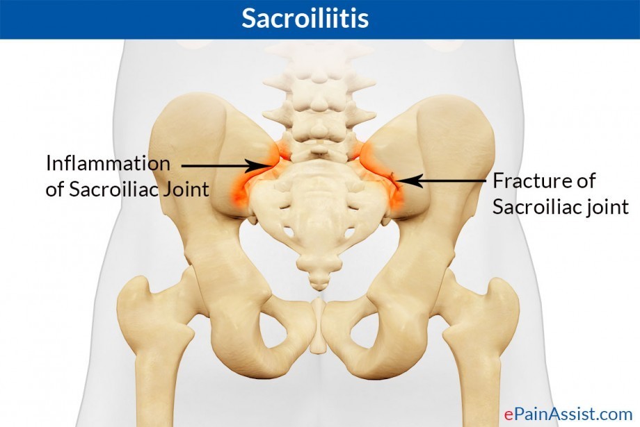Sacroiliitis: Causes, Symptoms, Treatment- Medications, Sacroiliac Joint Injections care of http://www.epainassist.com/