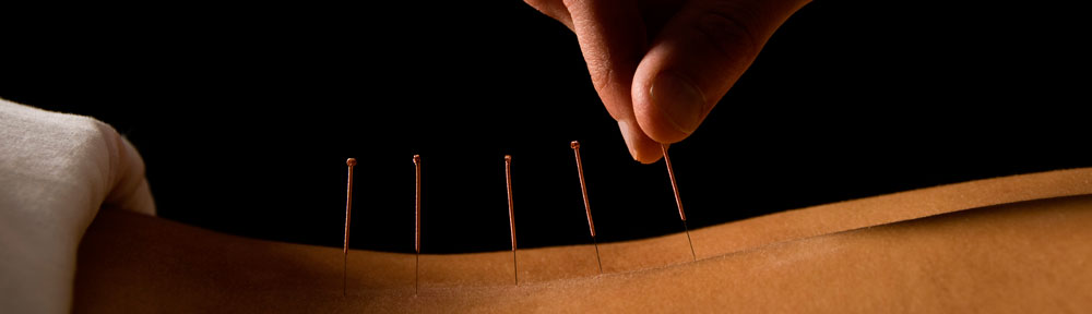 Preventing Disease and Injury With Acupuncture [Guest Post]