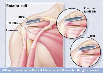 rotator injury tendonitis