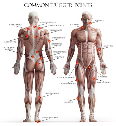 Common Trigger Points