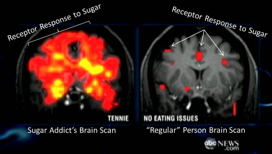 Sugar on the brain