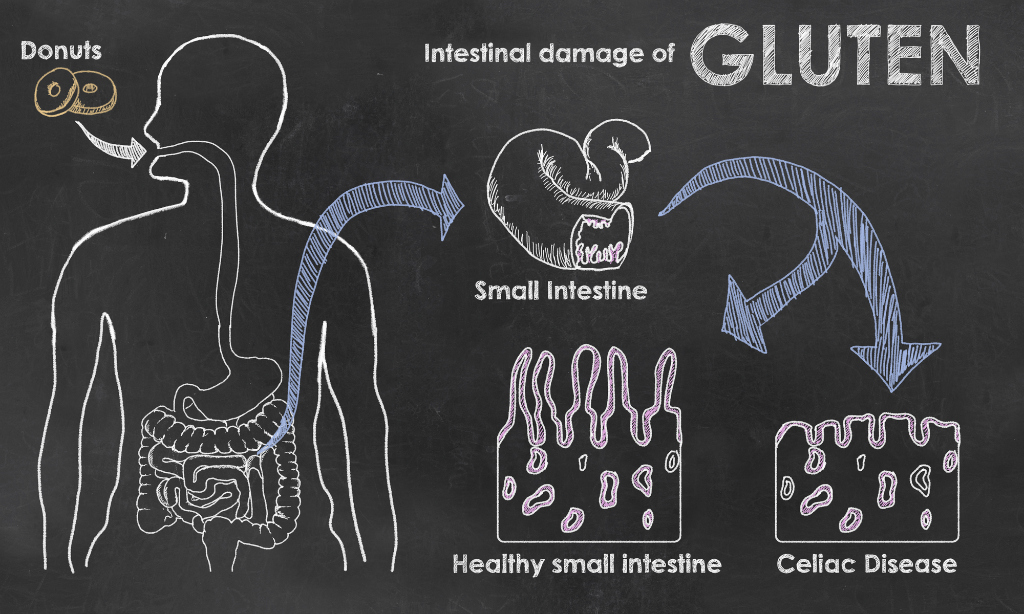 Intestinal Damage of Gluten on a Blackboard