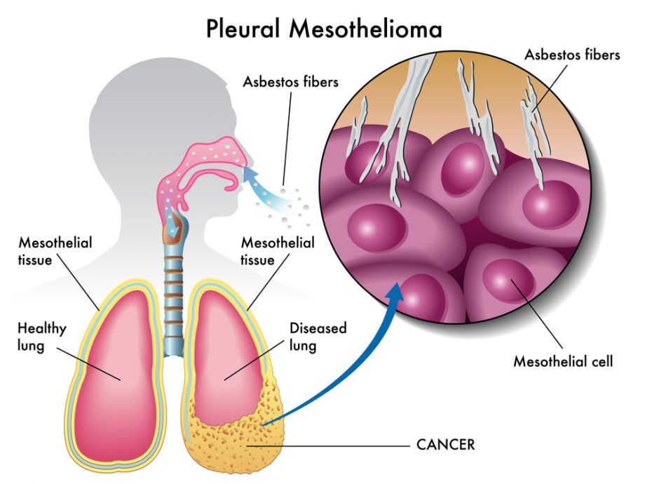 pleural mesothelioma