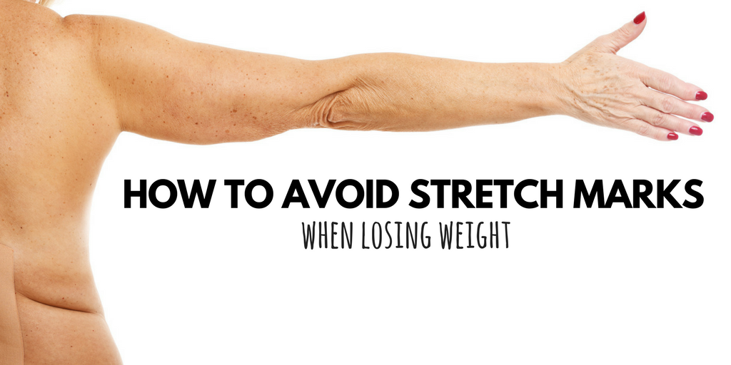 How to Avoid Stretch Marks When Losing Weight