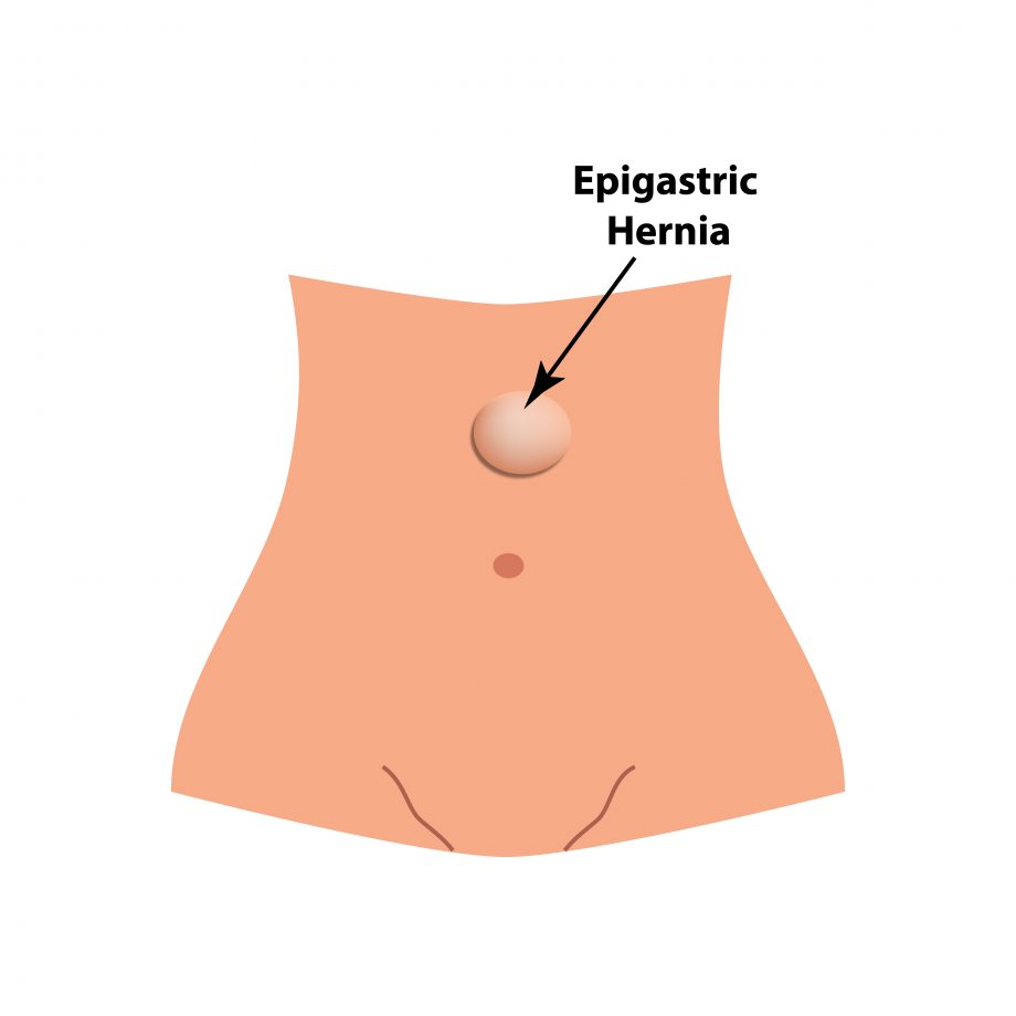 An epigastric hernia. intestinal hernia. Infographics. Vector illustration on isolated background